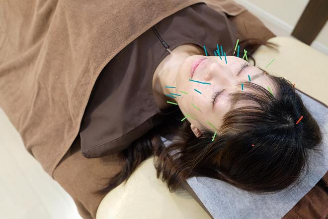 美容はり - 画像1