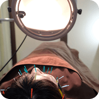 鍼での施術中の写真