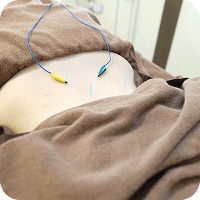 鍼での施術中の写真